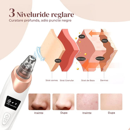 Aparat Extractie Puncte Negre Elindor®  3 Moduri de Putere, 5 Capete Speciale, Aspirator Profesional pentru Pori, Alb